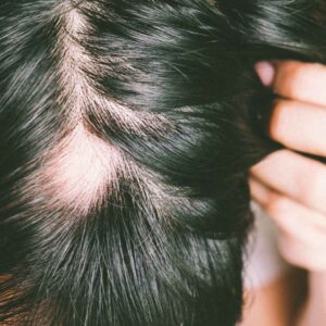 partial hair loss
